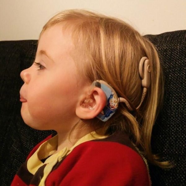 What is cochlear implant and how it works?