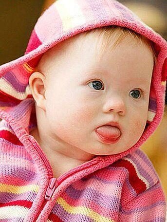 What are early signs and symptoms of down syndromes in newborns?