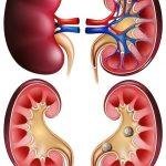 kidney pain and disability